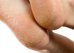 ترمیم ترک‌های کف پا با ترکیب چند ماده طبیعی