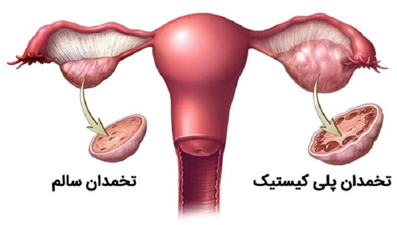 افراد مبتلا به pco با چه عوارضی روبه رو می‌شوند؟ / با رعایت رژیم غذایی این بیماری را کنترل کنید