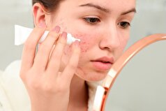 اظهارات یک متخصص زیبایی| چگونه قرمزی صورت را کاهش دهند