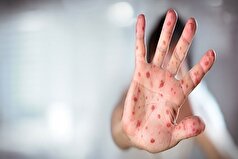 بسیاری سرخک در افراد مختلف چگونه بروز پیدا میکند؟