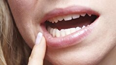 ترک‌ها یا زخم‌های ایجادشده در گوشه‌های دهان چه علتی دارند؟