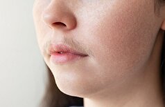 موی صورت در زنان: چه زمانی طبیعی است و چه زمانی جای نگرانی دارد؟