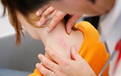 ارتباط پسوریازیس شدید با بیماری قلبی