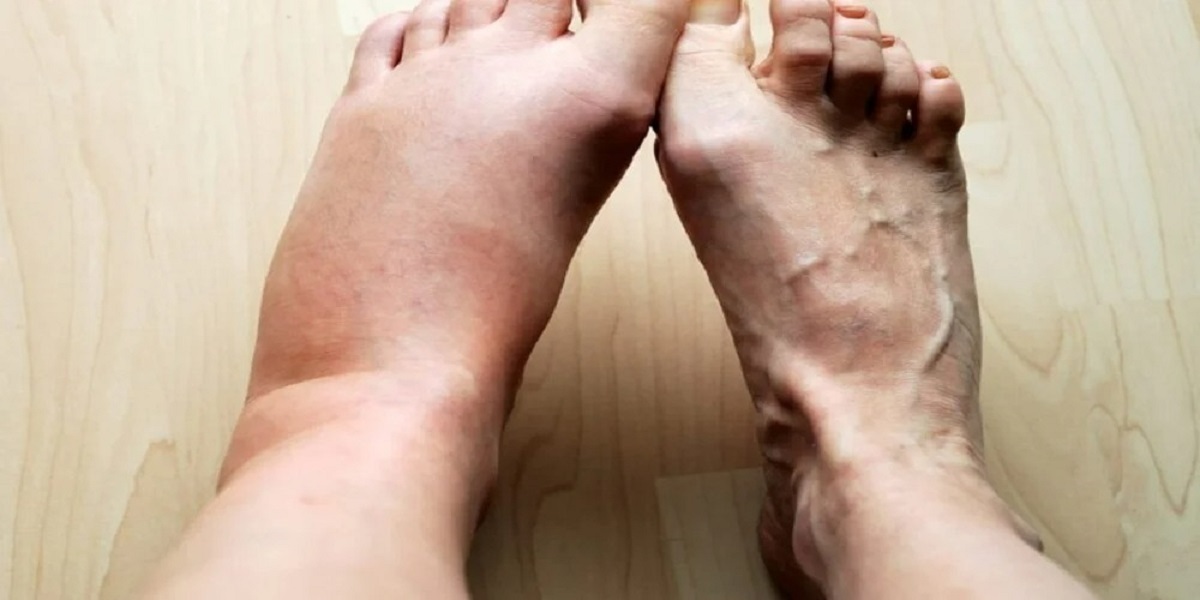 علائم پنهان دیابت را بشناسید