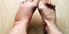علائم پنهان دیابت را بشناسید