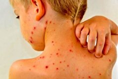بیماری سرخک مجددا بازگشته است؟
