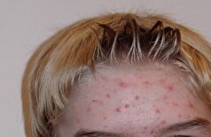 آیا آفتاب روی جوش صورت تأثیر دارد؟
