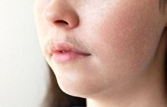 موی صورت در زنان ارتباط آن با مشکلات هورمونی