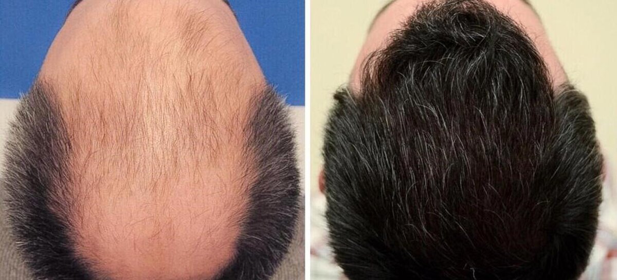 همه چیز درمورد امکان ریزش مو بعد از کاشت