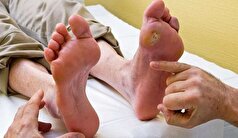 راهکار‌های کاربردی برای پیشگیری از به وجود آمدن زخم پا در بیماران دیابتی