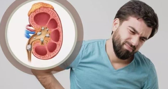 دفع سنگ کلیه با مصرف نوشیدنیهای الکلی، واقعیت یا خیالات؟ دفع سنگ کلیه با مصرف نوشیدنیهای الکلی، واقعیت یا خیالات؟