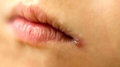 کیلیت زاویه‌ای یا همان زخم‌های گوشه دهان ناشی از چیست؟