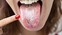 حملات مکرر برفک دهان ممکن است نشانه نامحسوس دیابت باشد