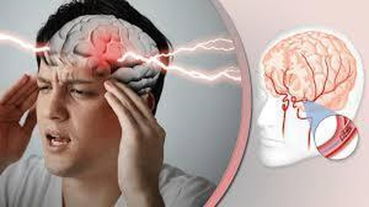 علائم اولیه سکته مغزی را جدی بگیرید!