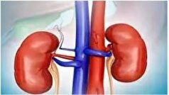 مصرف مشروبات الکلی باعث دفع سنگ کلیه می‌شود؟