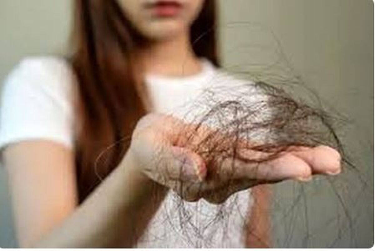 نقش کمبود‌های تغذیه‌ای و هورمونی بر ریزش مو
