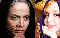 نگاهی به گریم‌های سنگین بازیگران با بیماری پوستی+تصاویر