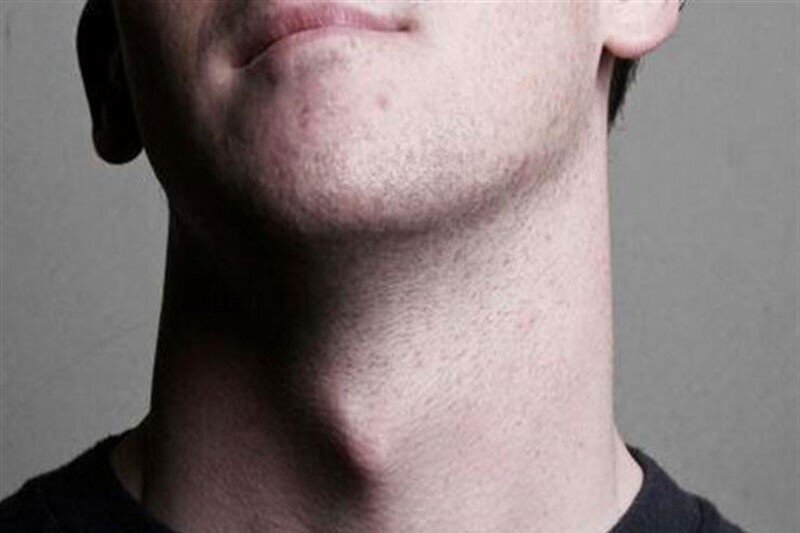 آیا داشتن سیب آدم برجسته خطرناک است؟ چه زمانی نیاز به جراحی پیدا می‌کنید؟