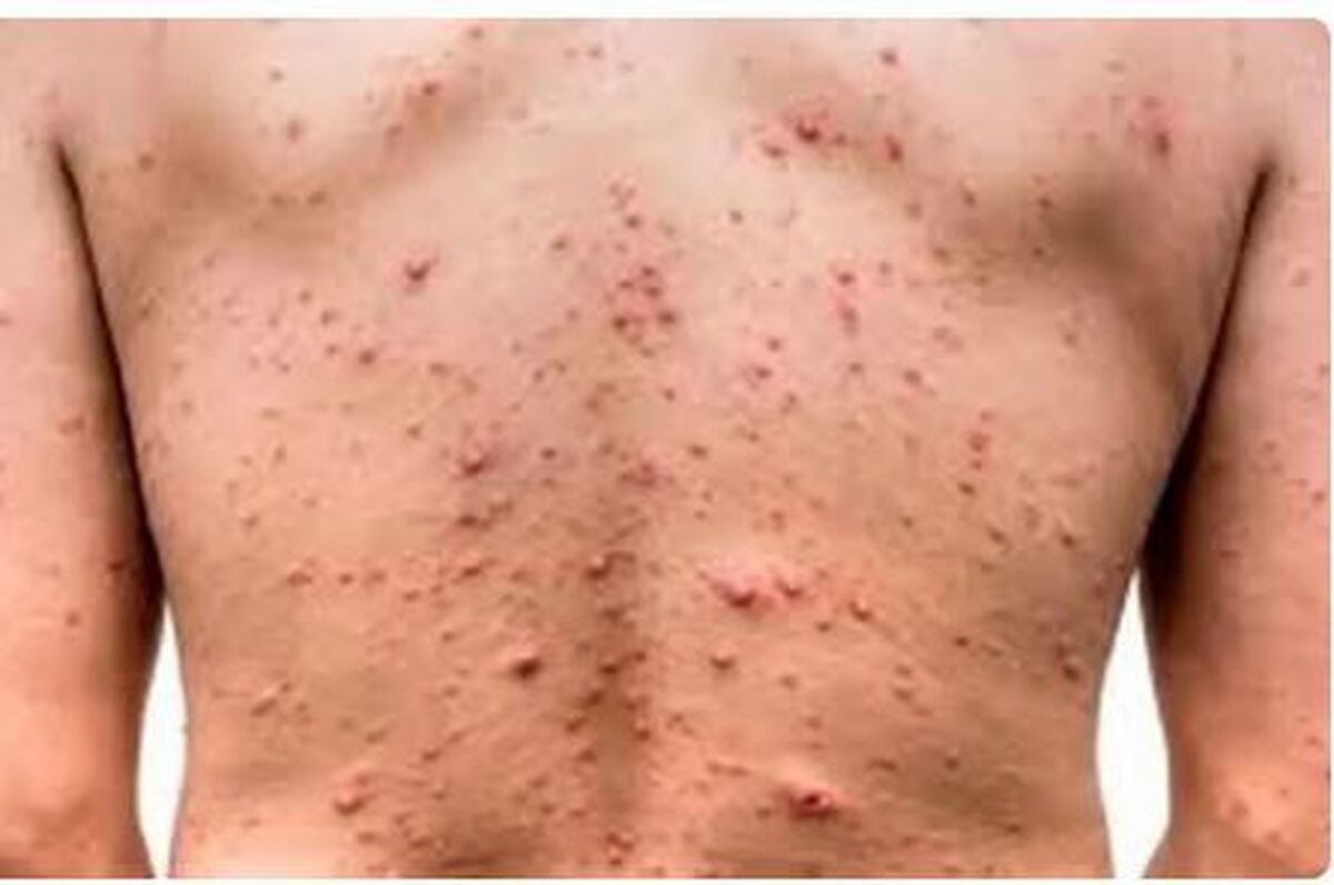 این دسته از افراد حتما واکسن آبله مرغان بزنند