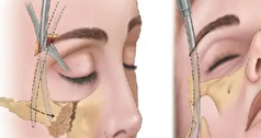 شکستگی‌های ناحیه صورت چه مشکلاتی ایجاد میکنند؟