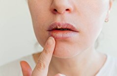 فناوری جدید ویروس تبخال را خنثی می‌کند و فرصت‌های پیشگیری را فراهم می‌کند