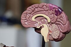 سن بروز سکته‌های مغزی در جامعه رو به کاهش است!