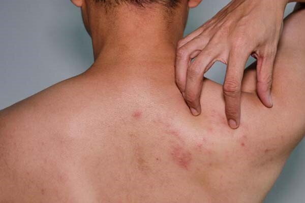 چگونه از جوش روی کمر خلاص شویم؟ علت بوجود آمدن این جوش‌ها چیست؟
