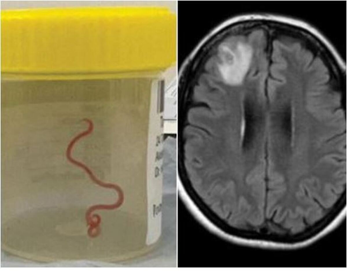 خام خواری منجر به رشد کرم در مغز یک مرد شد