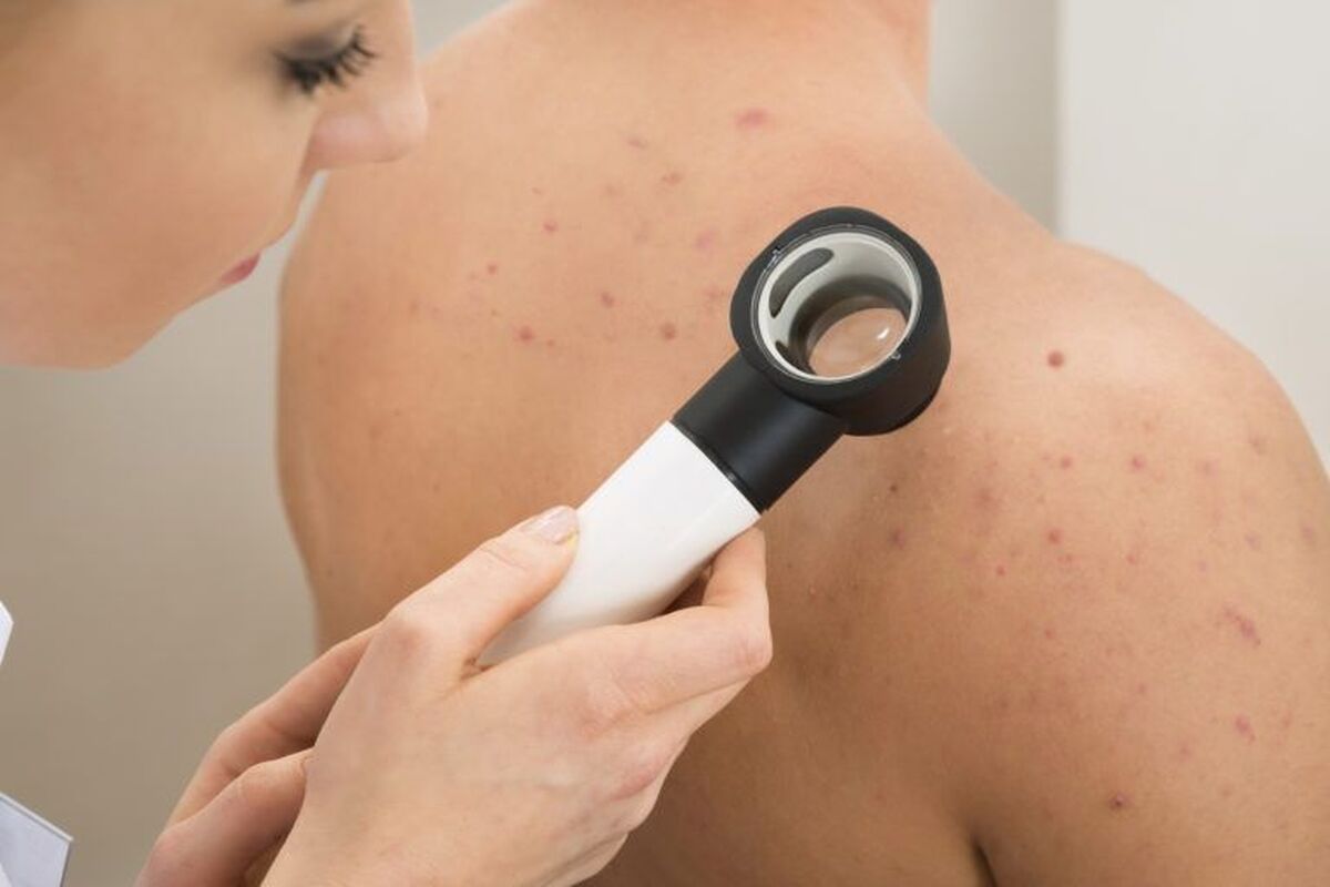 چرا روی کمر جوش میزنیم؟