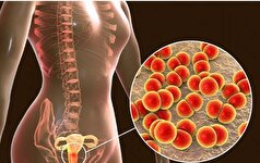 سوزاک؛ یک بیماری مقاربتی کمتر شناخته شده در بین عموم/از علائم تا درمان