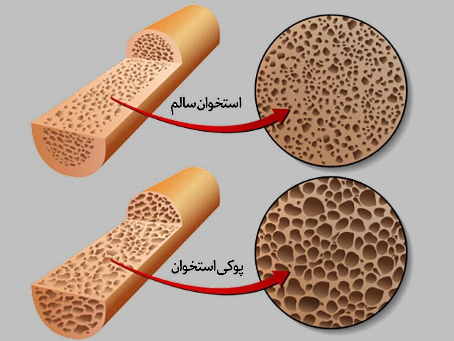 با این ورزش ریسک شکستگی استخوان را در سنین بالا کاهش دهید