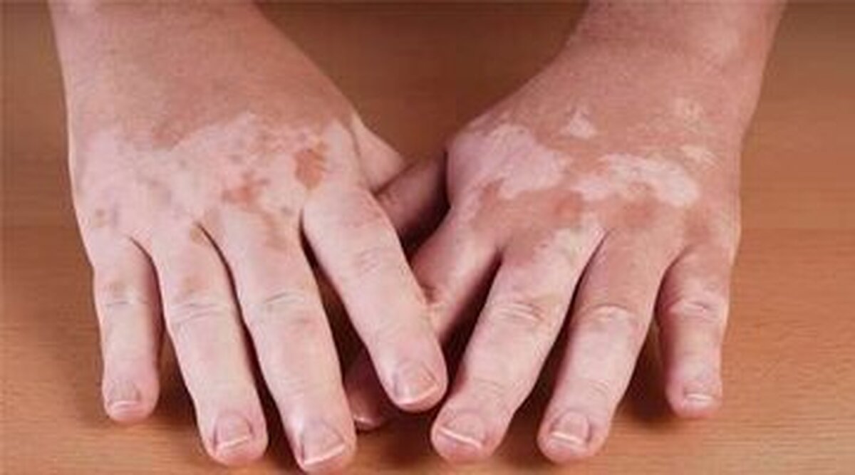 بیماری ویتیلیگو یا پیسی چگونه تشدید می‌یابد؟