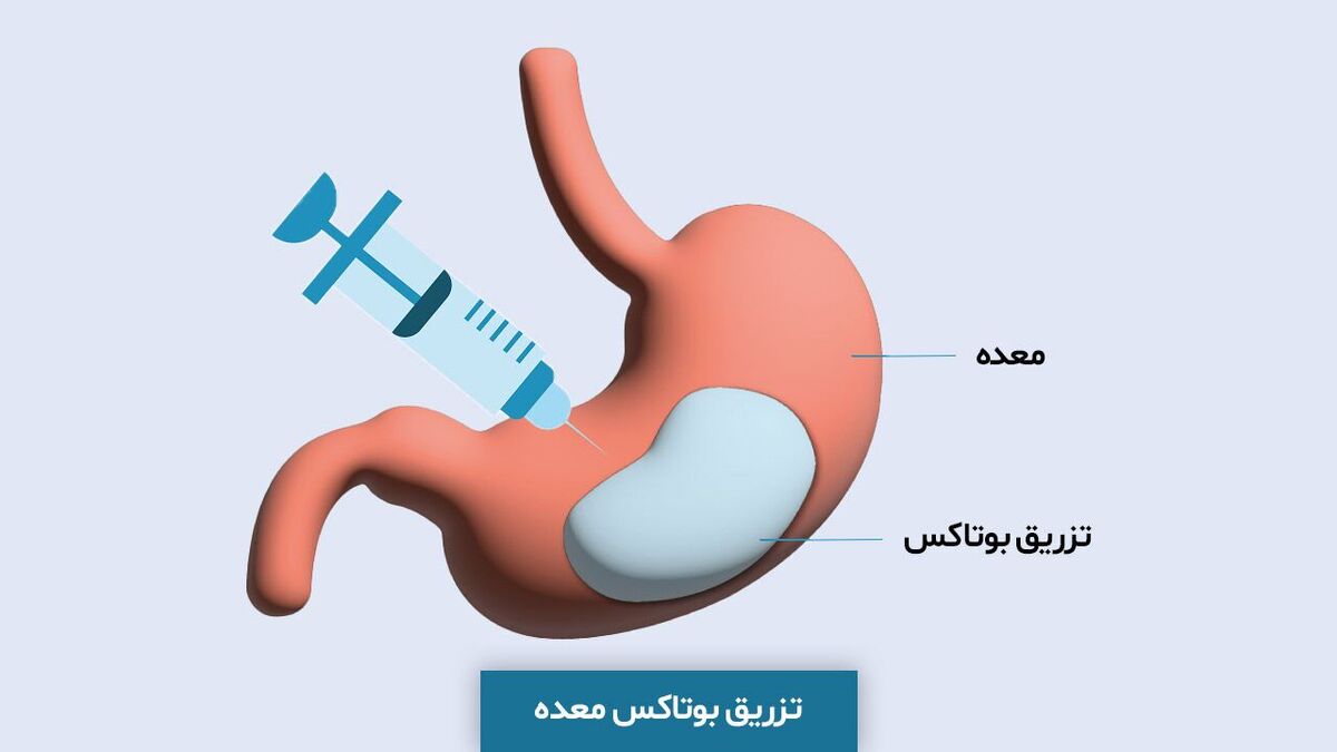 بوتاکس معده برای لاغری جواب میدهد؟!