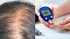 چند اقدام درمانی برای پیشگیری از ریزش موی ناشی از دیابت