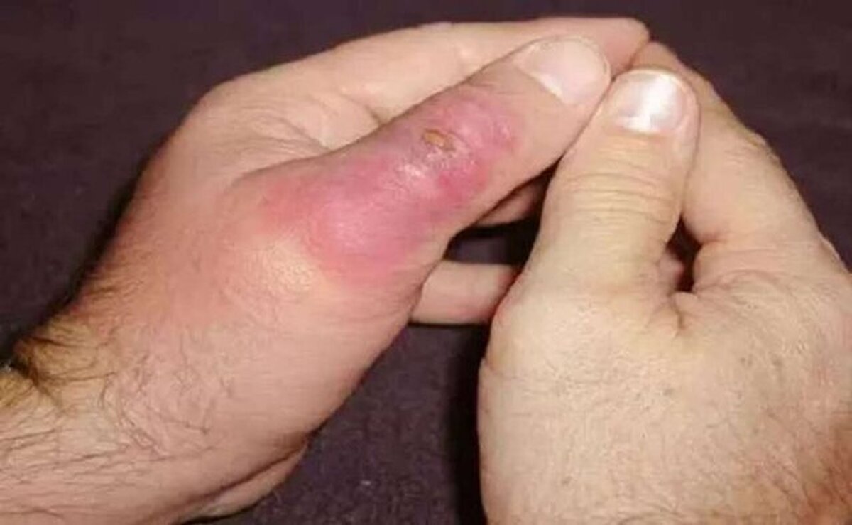اگر با فرد مارگزیده مواجه شده این کار‌ها را نکنید