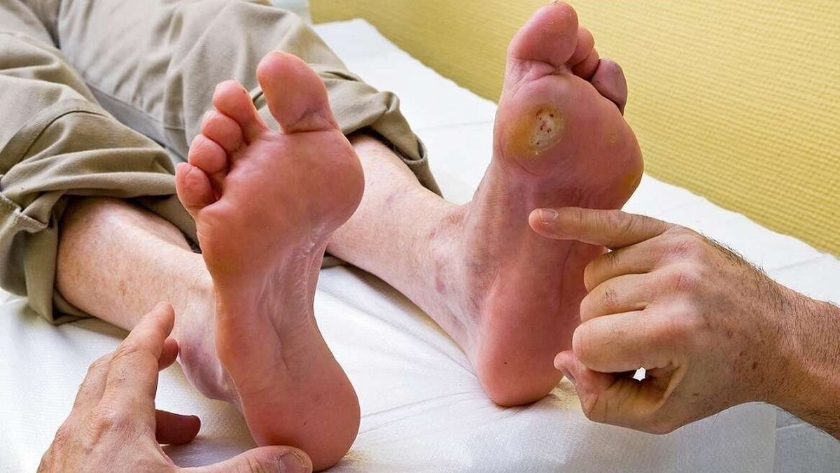 مراقبت درست و مستمر برای پیشگیری از «زخم پای دیابتی»