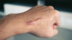 تشکیل اسکار پس از آسیب نخاعی، فرآیندی پیچیده‌تر است