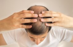 ممکن است یک دلیل غیرمنتظره پشت طاسی شما باشد!