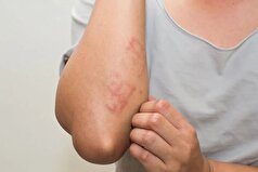 مدیریت بیماری سلیاک چگونه اتفاق می‌افتد؟