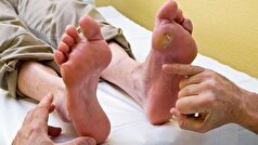دیابت نوع ۲ چه مشکلاتی برای پا ایجاد میکند؟