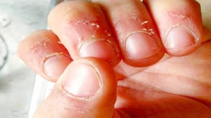 چرا اطراف ناخن پوست‌پوست می‌شود؟ +راه درمان!