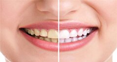 مزاج چه تاثیری بر رنگ دندان دارد؟