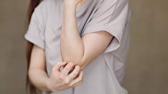 صحبت‌های یک متخصص درباره خطرات نیش پشه