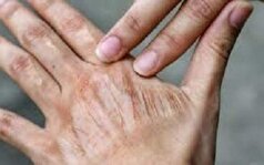 لک‌های پوستی به چه دلیلی ایجاد میشوند؟