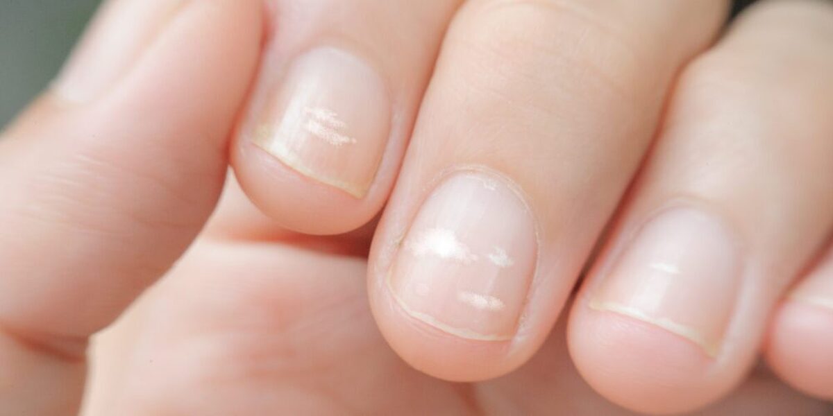 JAMA Dermatology: تغییرات ناخن ممکن است نشان دهنده خطر سرطان باشد