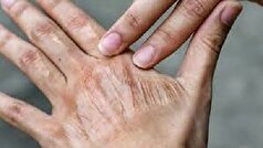 ملانین پوست چگونه تغییر میکند؟