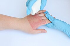 چگونه عوارض سوختگی درجه سه را کمرنگ‌تر کنیم؟