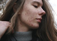 باکتری‌های مسئول آکنه برای درمان آن از نظر ژنتیکی اصلاح شده‌اند