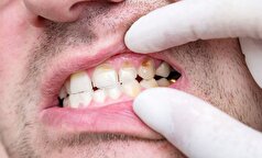 پوسیدگی دندان قابل درمان است؟