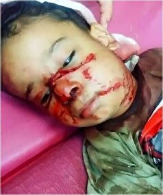 کودک خوزستانی مورد حمله سگ ولگرد قرار گرفت